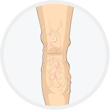 organe varicoase de tratament pelvis mic