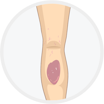 Operaiunea varicleoza pe picioare cu un laser, Operațiunea varicleoza pe picioare la bărbați
